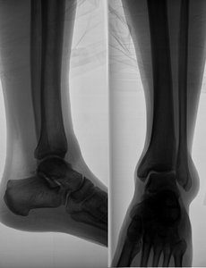 Imagem de raios-X da perna